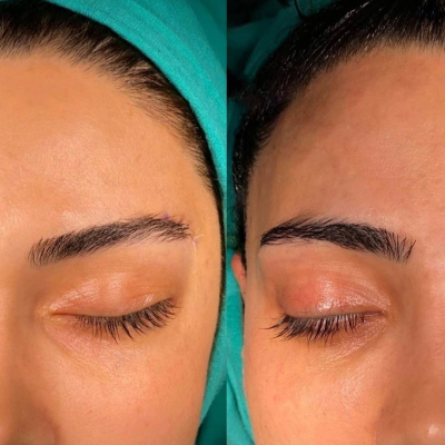 لیفت شقیقه و پیشانی